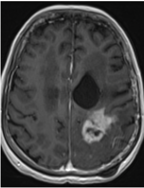 MRI of patient with a GBM detected in 2001. New increased contrast area in 2022